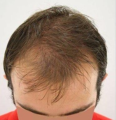 Before Hair Transplant
