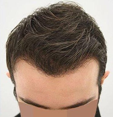 After Hair Transplant